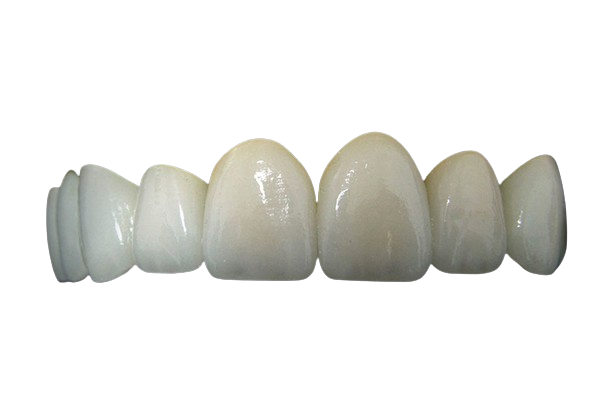 Multilayered Zirconia Crown(s)